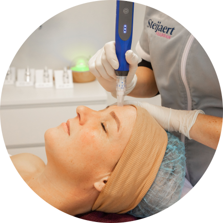 microneedling-charlotte-steijaert-huidgezondheid-3