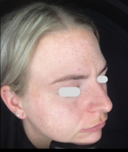 microneedling-tegen-acne-littekens-charlotte-steijaert-huidgezondheid-1