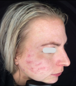 microneedling-tegen-acne-littekens-charlotte-steijaert-huidgezondheid-2