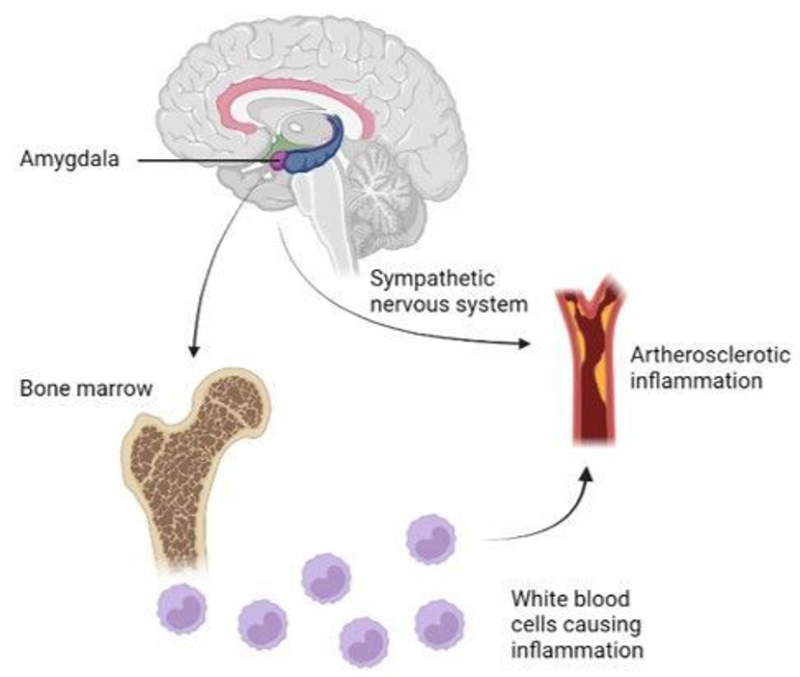 Chronic stress increases the risk for the development of cardiovascular disease through the amygdala, the bone marrow and the sympathetic nervous system