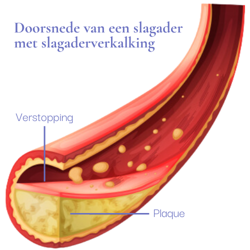 dichtgeslibde-aderen-annet-steijaert-sweet60 dichtgeslibde-aderen-annet-steijaert-sweet60