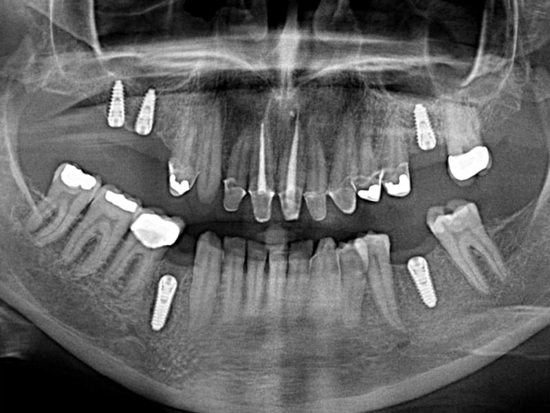 Gebitsrenovatie kan je laten doen wanneer je tanden rot of versleten zijn. Je krijgt hiermee simpel nieuwe tanden...
