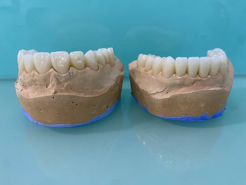 Deze Nieuwe tanden hebben wij gemaakt in onze albanese tandartskliniek.