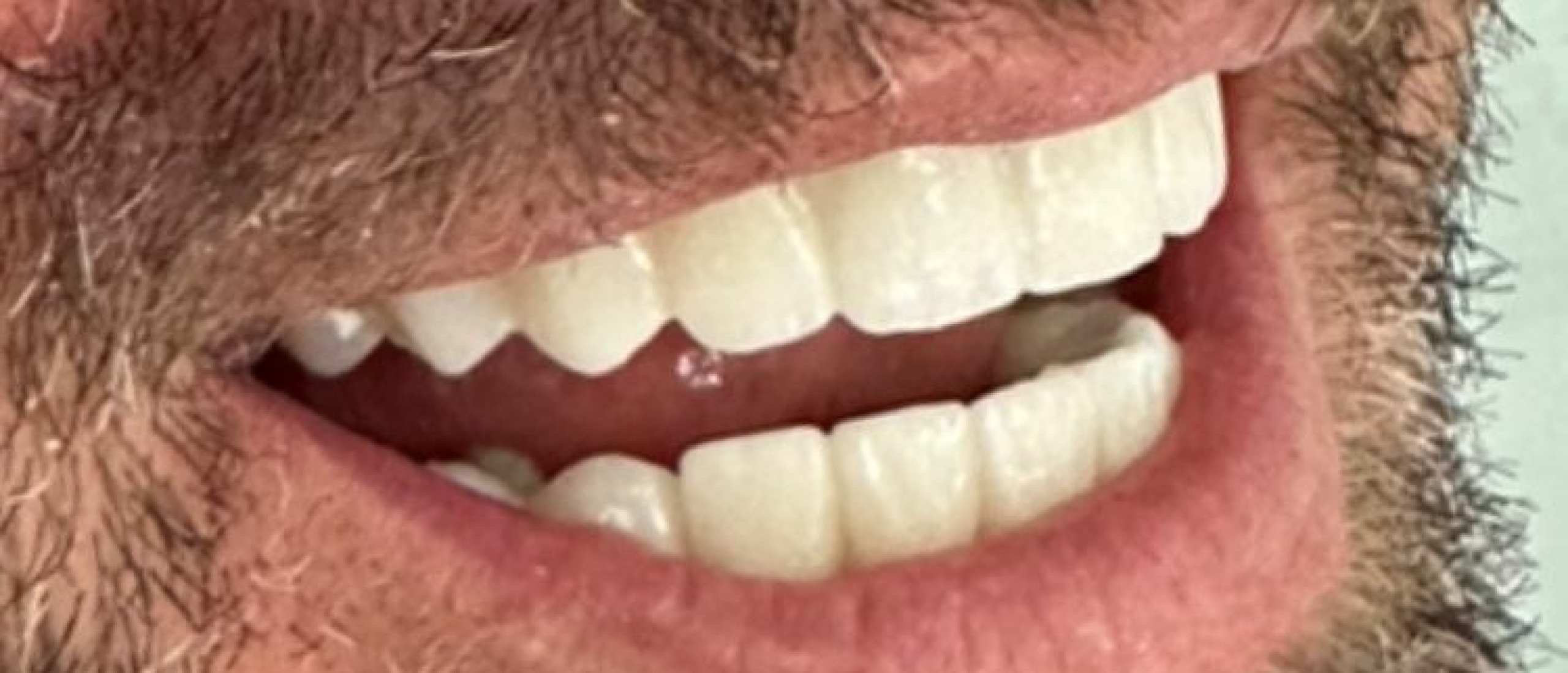 De Werkwijze van tanden Laten Slijpen en Kronen Plaatsen [Megagids]