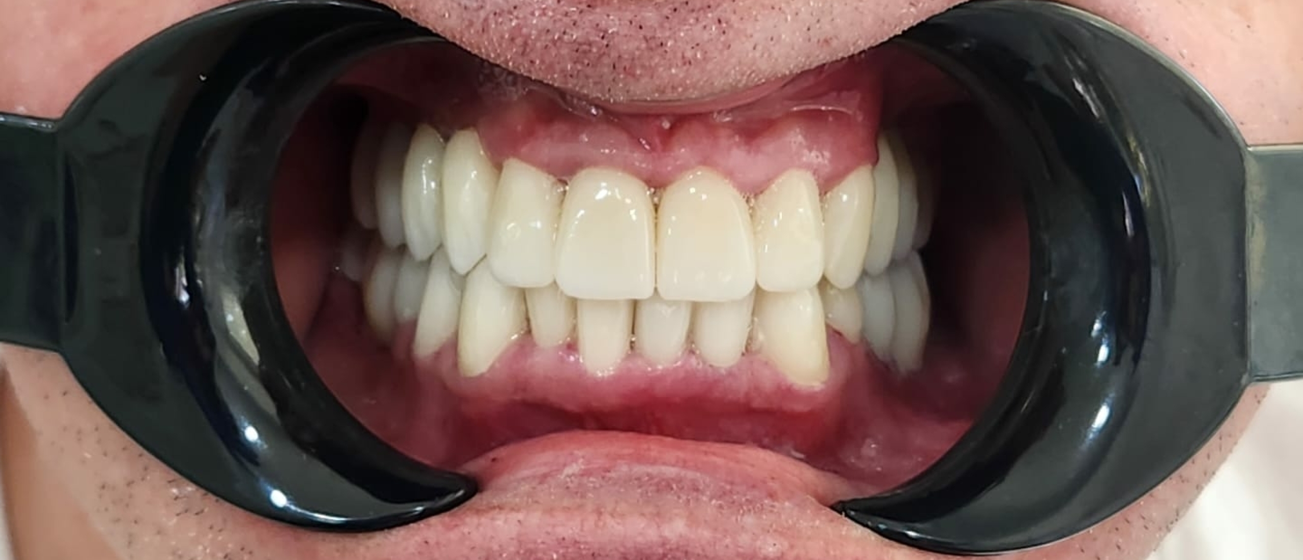Help, ik wil nieuwe tanden: Een concreet stappenplan richting gebitsrenovatie