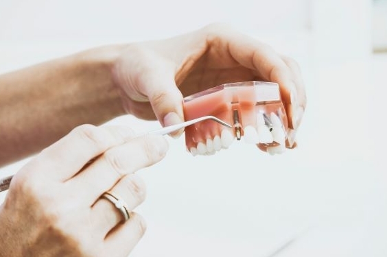 Een Implantaat in je gebit kan zorgen dat jij stevigere tanden krijgt. Het maakt het mogelijk om voor lange termijn te behouden.
