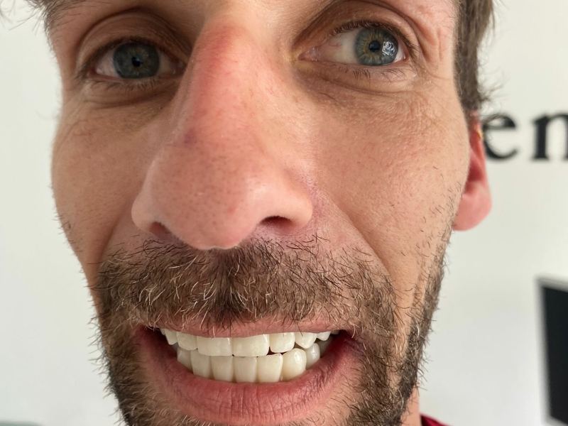 Deze Gebitsrenovatie op implantaten was voor een Nederlandse patiënt! Tanden werden getrokken en 12 implantaten vormden de basis voor 24 zirkonium kronen.
