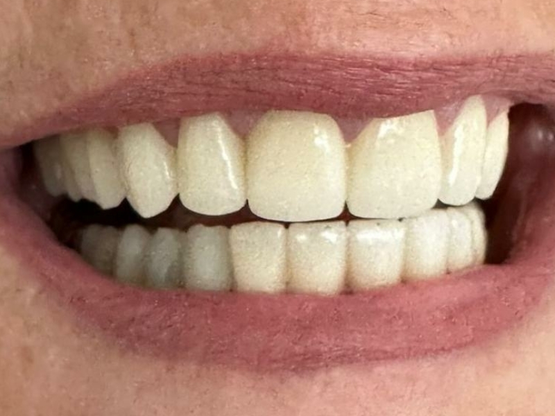 Deze tanden maakten wij voor onze Nederlandse klant Rita! Ze kwam voor Gebitsrenovatie naar onze tandartspraktijk in Albanie.