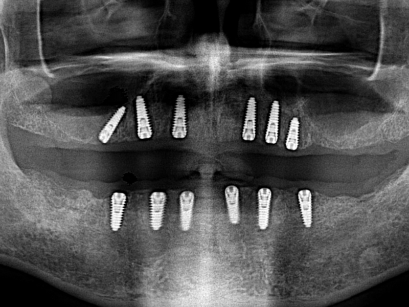 Bij een All on Six gebitsrenovatie worden alle tanden getrokken en tand implantaten geplaatst. Na 4 maanden genezingstermijn maken wij hier een constructie van 24 zirkonium kronen op vast.