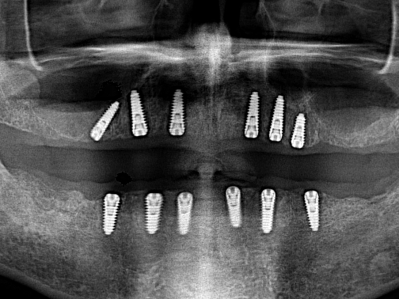 Bij een All on Six gebitsrenovatie worden alle tanden getrokken en tand implantaten geplaatst. Na 4 maanden genezingstermijn maken wij hier een constructie van 24 zirkonium kronen op vast.