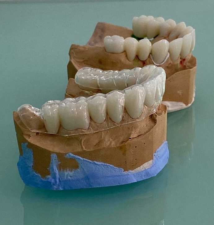 Rotte tanden leveren grote problemen op voor patienten in Europa. In onze kliniek helpen wij Europeanen naar een gezonder gebit en minder rotte tanden.