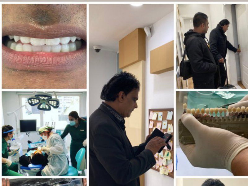 Deze gebitsrenovatie met nieuwe tanden op implantaten voerden wij uit in onze Albanese kaakchirurgie / tandarts kliniek.