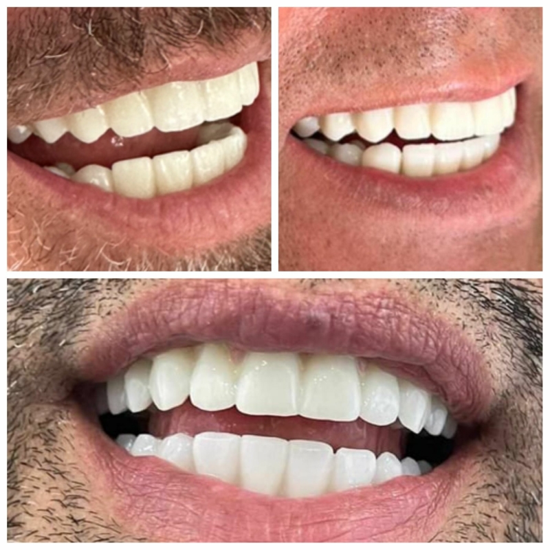 Deze nieuwe tanden maakten wij in 2023 voor Nederlandstalige klanten voor All on Six gebitsrenovaties