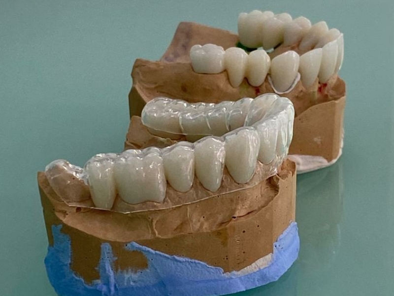 Deze nieuwe kronen hebben wij door onze tandarts in albanie laten ontwikkelen voor een Belgische client.