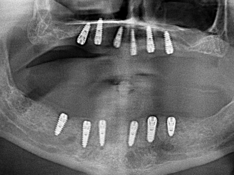 Op deze X-ray zie je het resultaat van een All on Six gebitsrenovatie met 12 titanium tand implantaten en 24 zirkonium kronen.