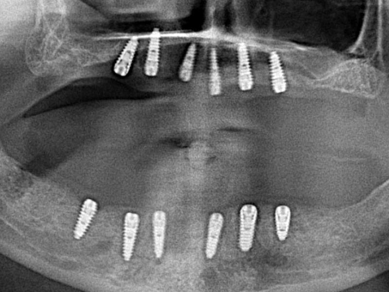 Op deze X-ray zie je het resultaat van een All on Six gebitsrenovatie met 12 titanium tand implantaten en 24 zirkonium kronen.