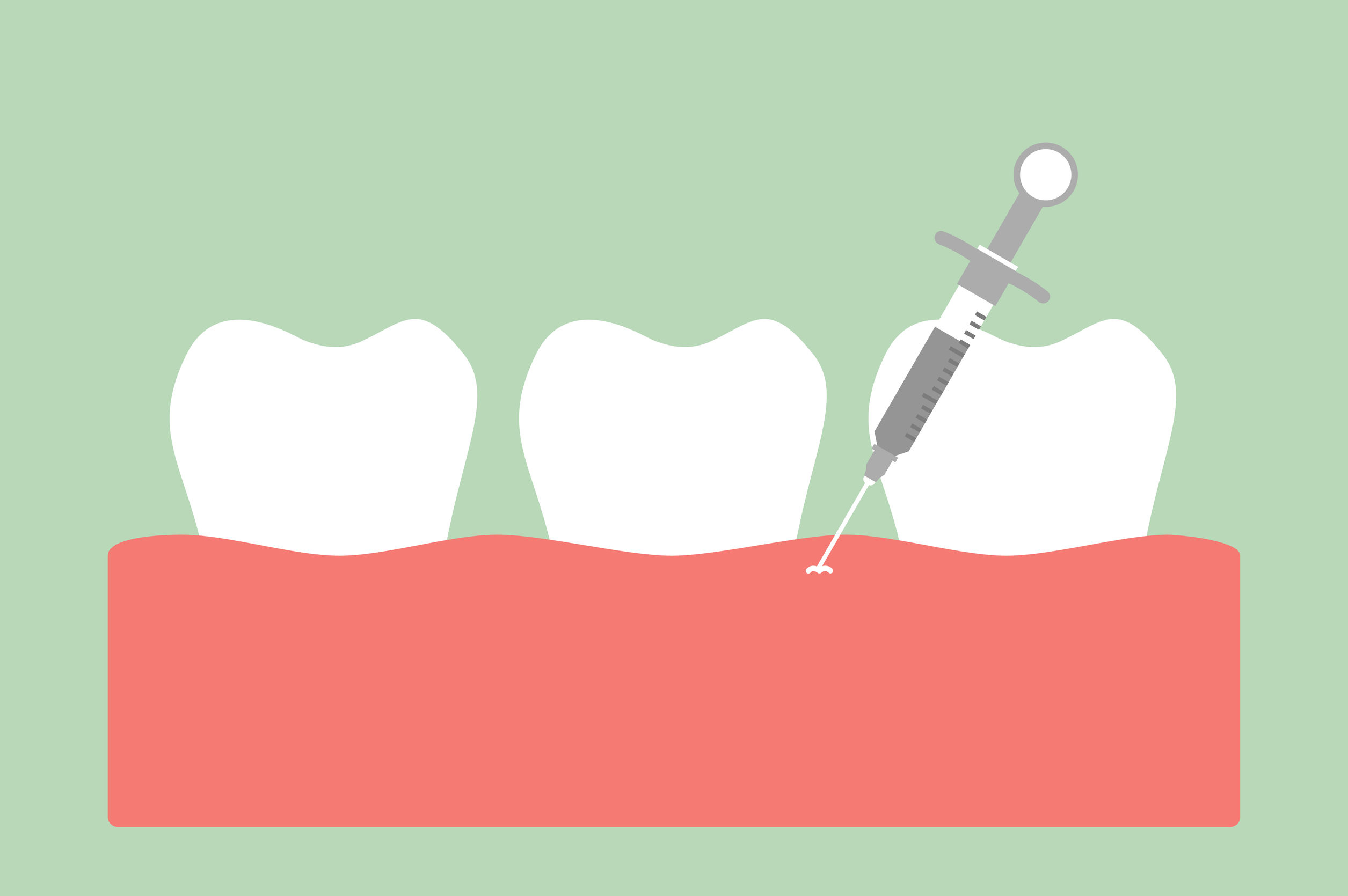 hoe werkt een verdoving bij de tandarts