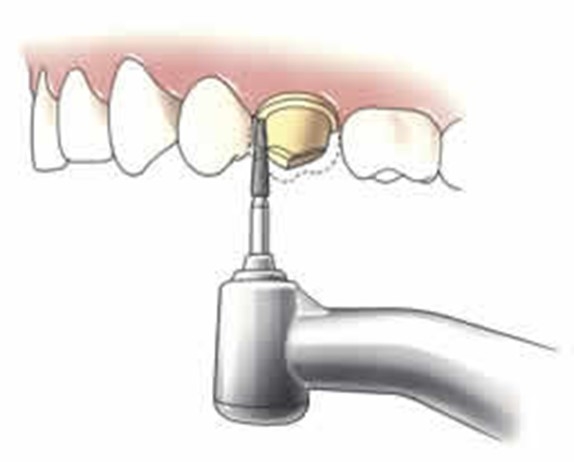 Behandeling bij Tandheelkunde Zonnestraal