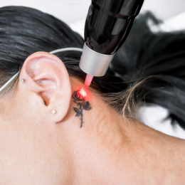 laser tattoo verwijdering
