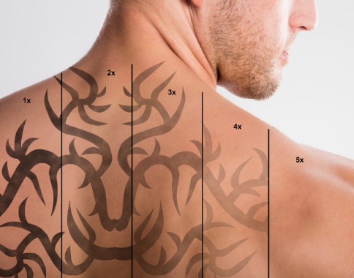 tattoo laser verwijderingsproces