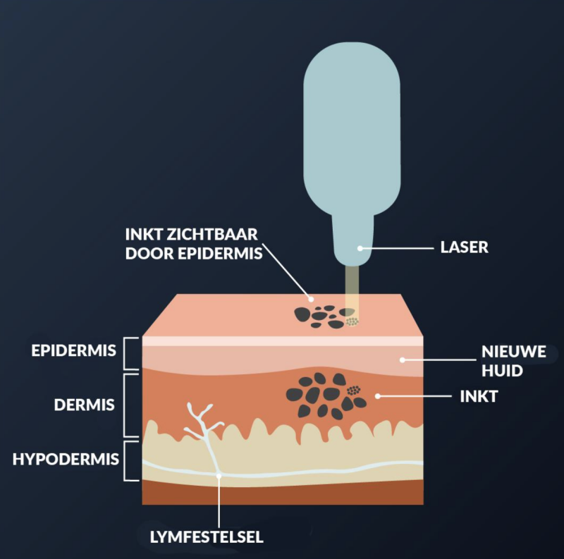 Waarom is mijn tatoeage donkerder na laserverwijdering?