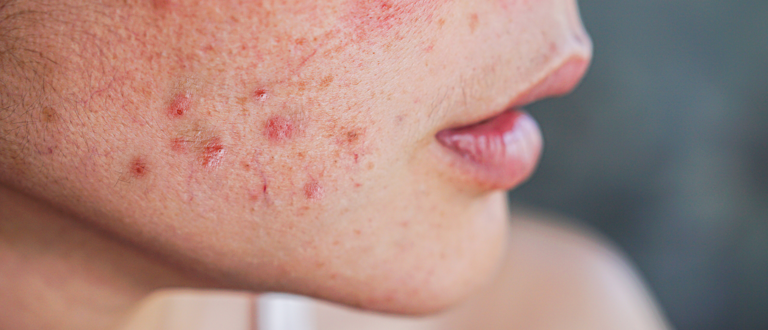 Hormonale acne ontmaskerd: Begrijpen en aanpakken