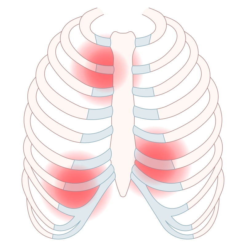 pijnplekken bij costochondritis