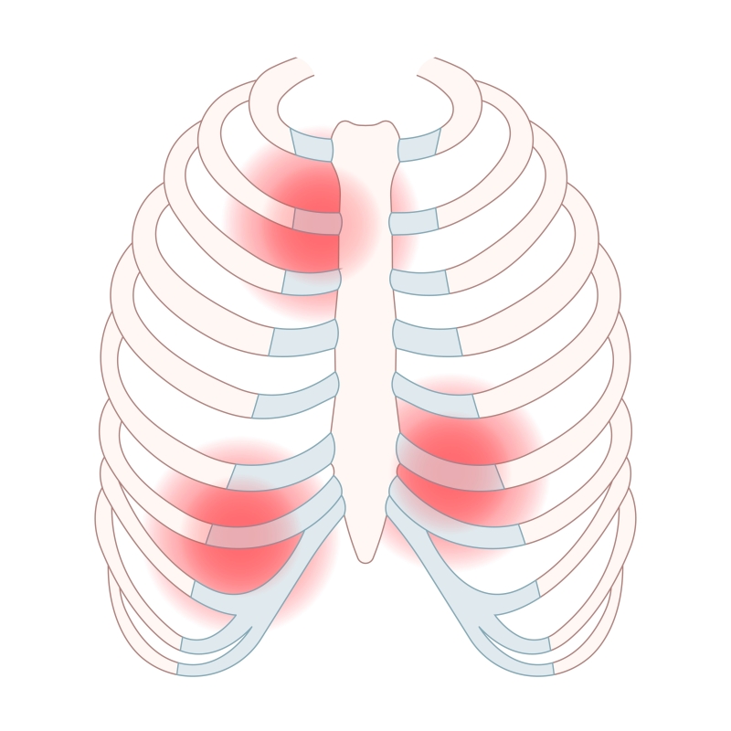 ontstoken borstbeen pijnplekken bij costochondritis en tietze