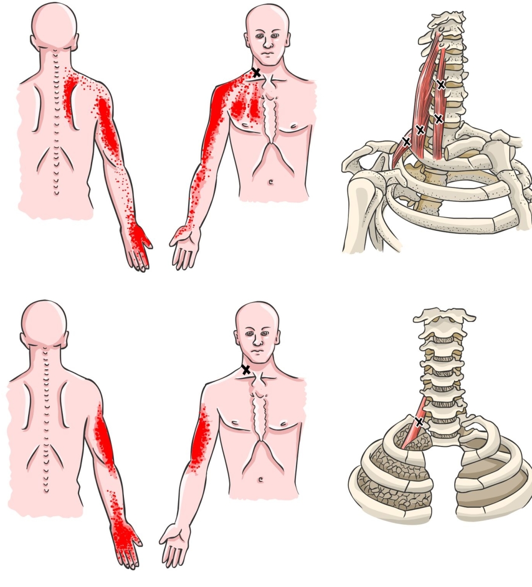 Herinnering transmissie Kreek Scaleni of schuine spieren: Pijn Reset Methode