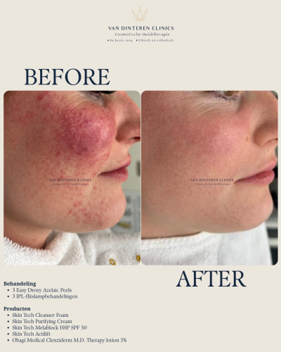 Resultaten behandeling couperose