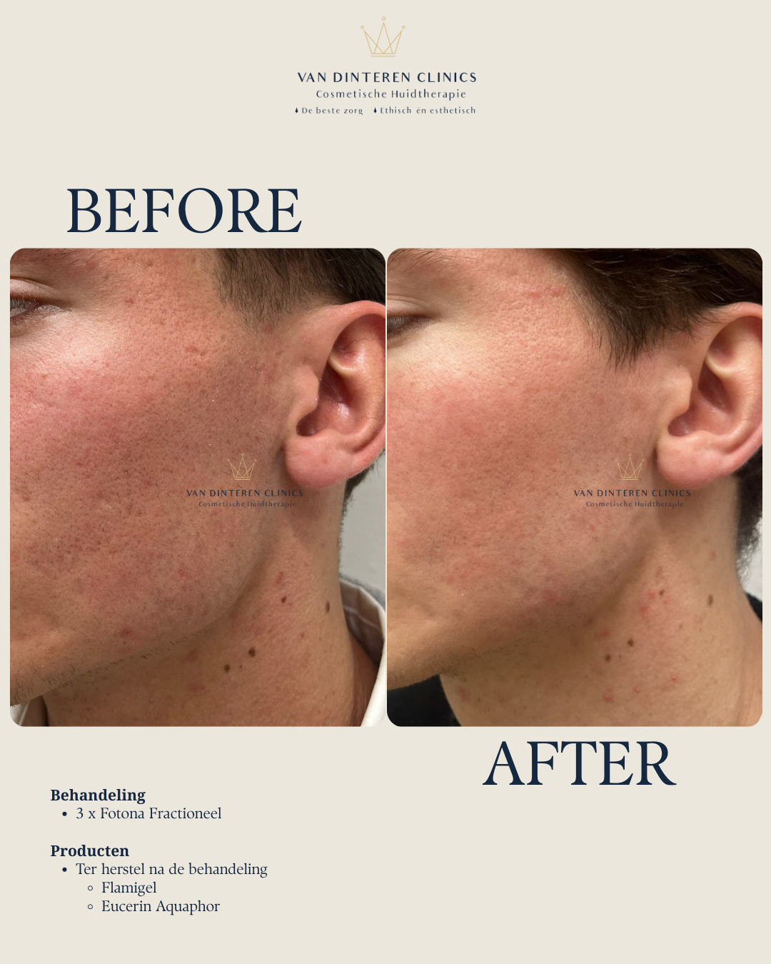 Resultaat behandeling littekens