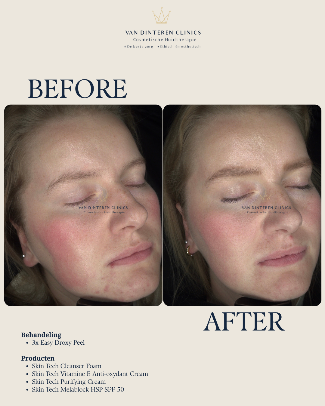 Resultaat verwijderen roodheden