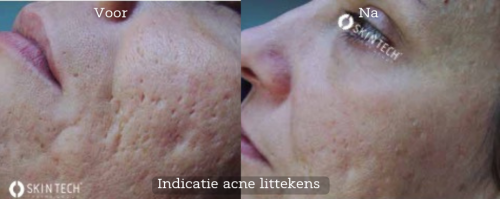 Behandeling acne littekens Pixel Peel