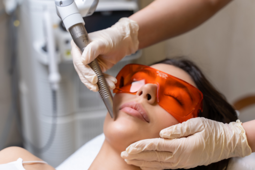 Liplase lipfillers natuurlijk Utrecht