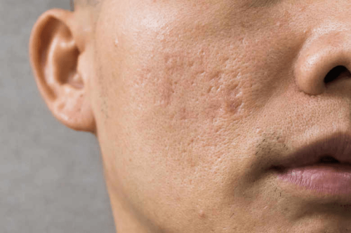 Littekenbehandeling Van Dinteren Clinics