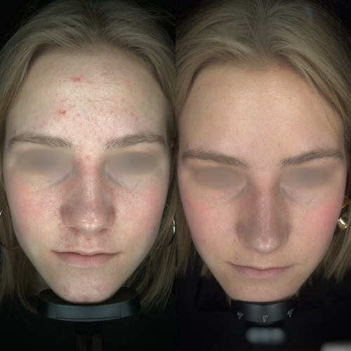 Resultaat acne behandeling