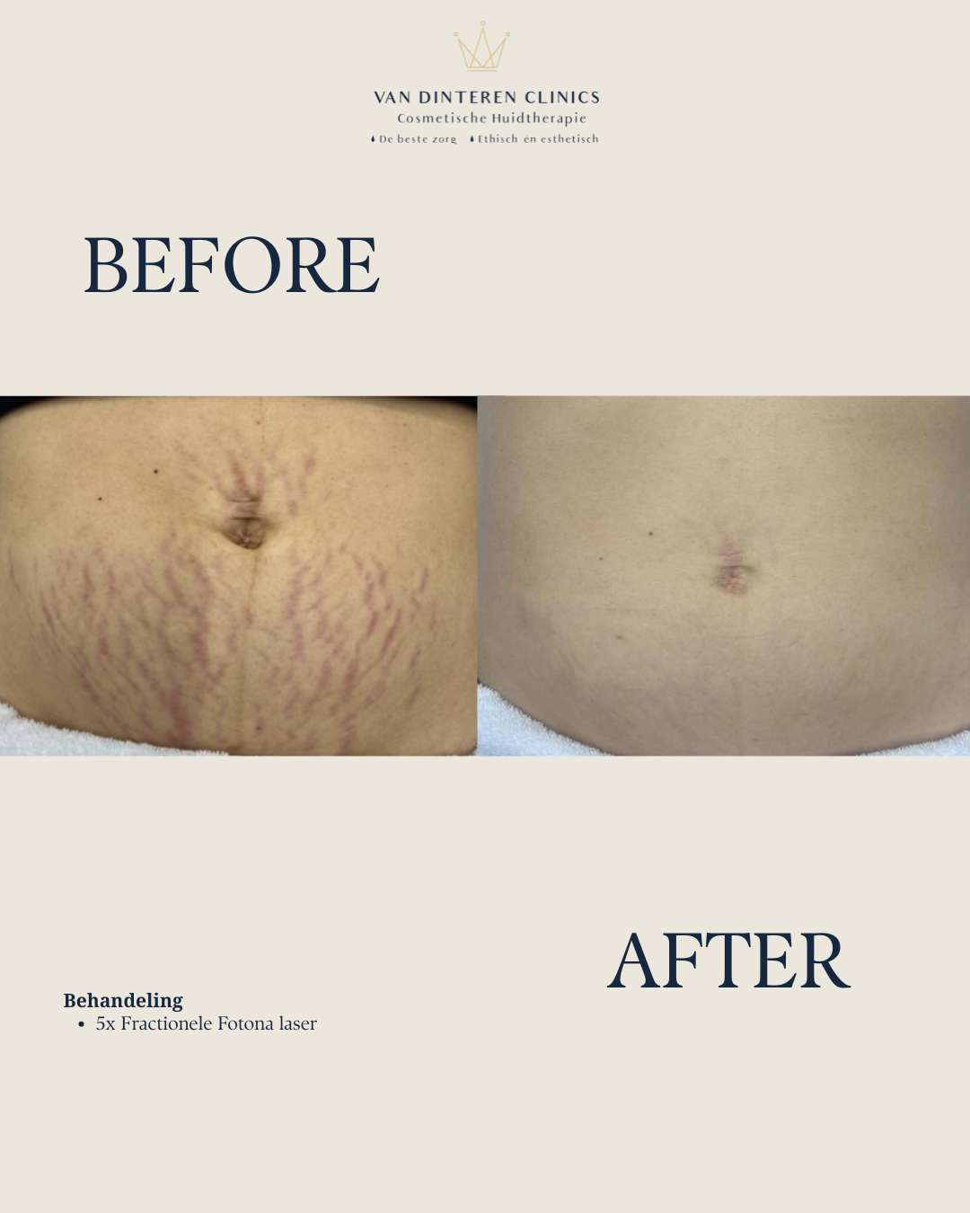 Resultaat behandeling striae laser