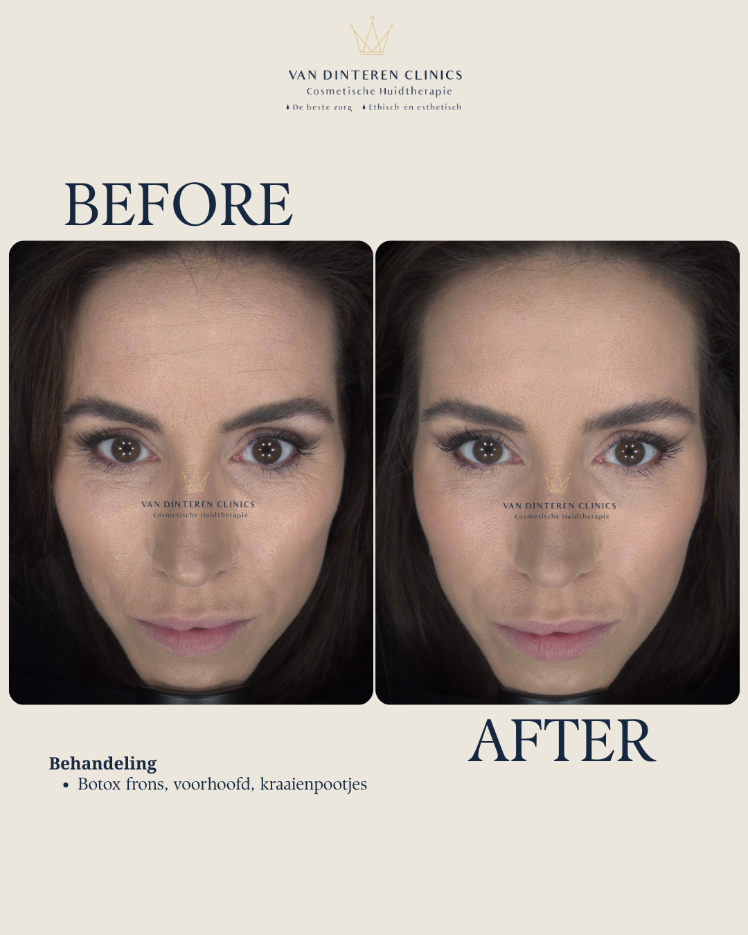 Resultaat huidverjonging Van Dinteren Clinics