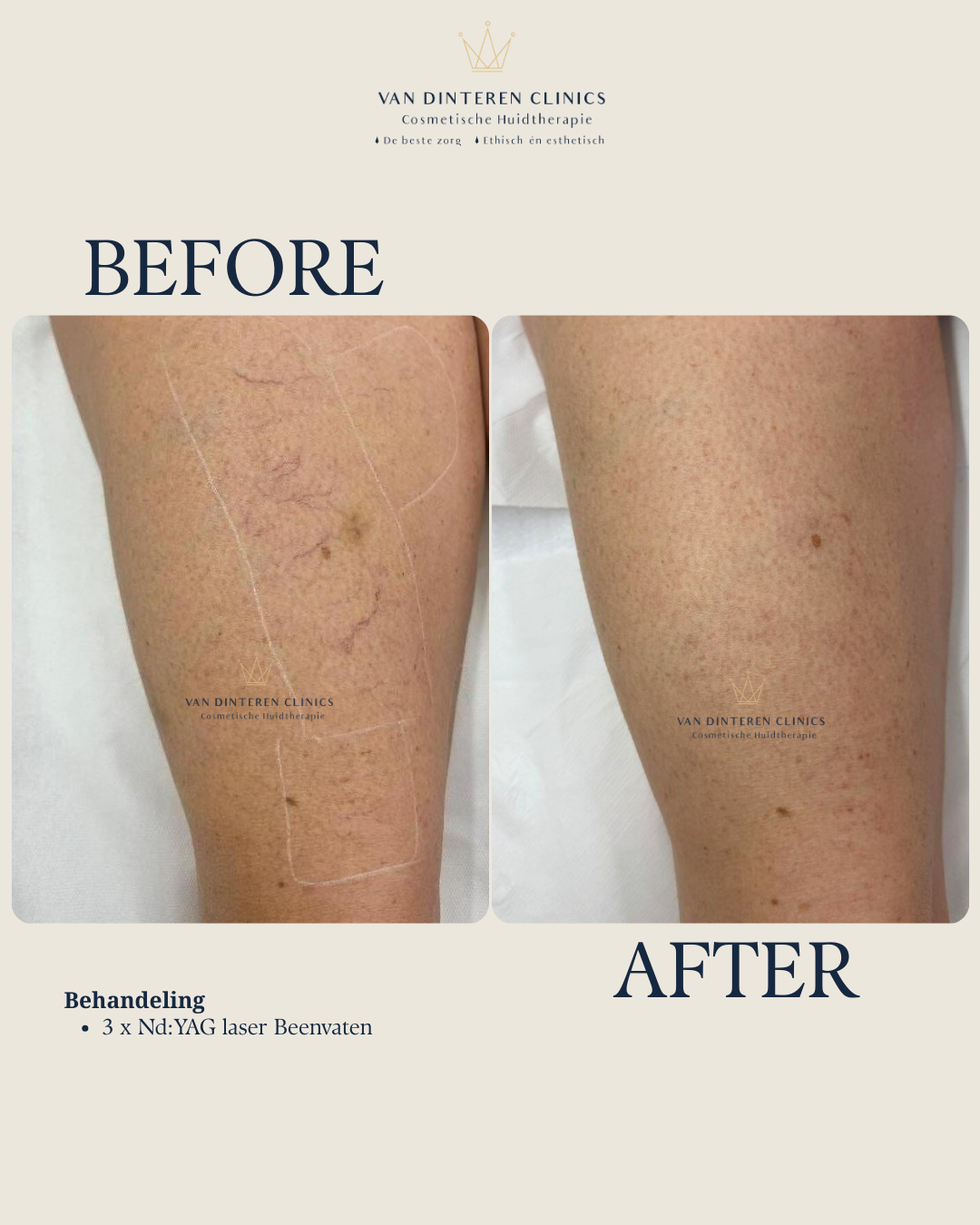 Resultaat laseren beenvaten