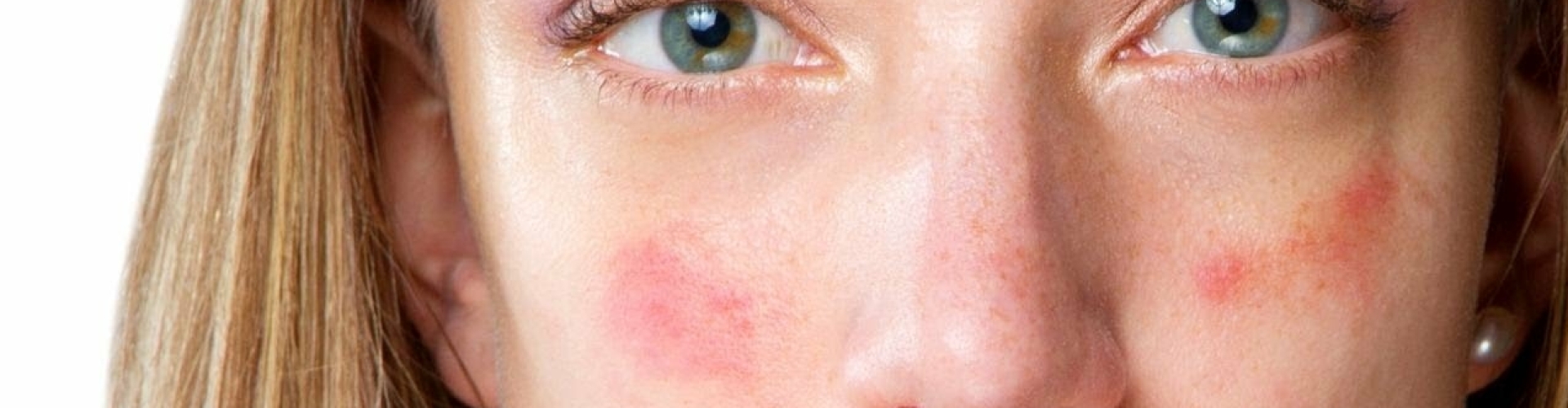 Rosacea behandelen Utrecht