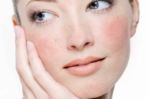 Rosacea behandelen Utrecht
