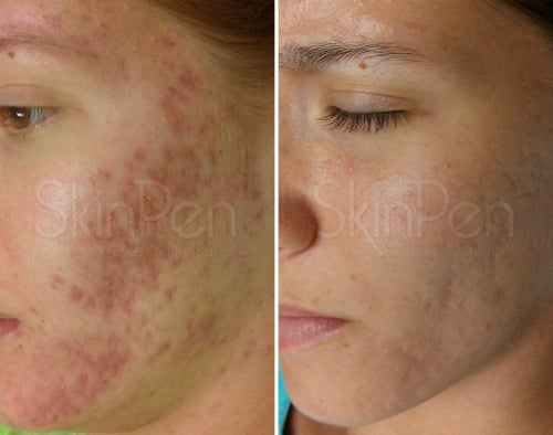 SkinPen Van Dinteren Clinics