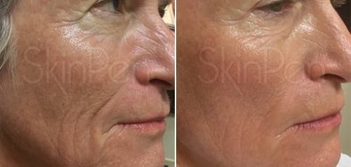 SkinPen Van Dinteren Clinics