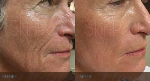 SkinPen Van Dinteren Clinics