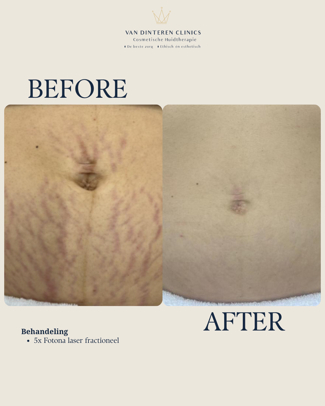 Striae behandelen Utrecht