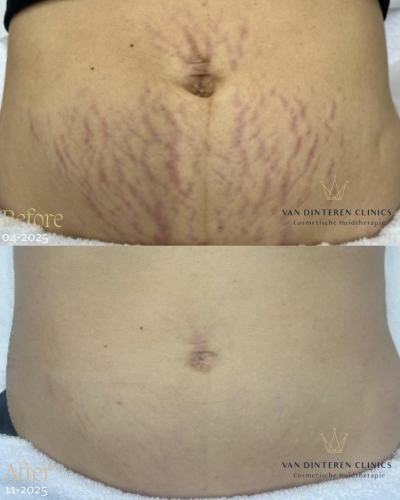 Striae behandelen Utrecht