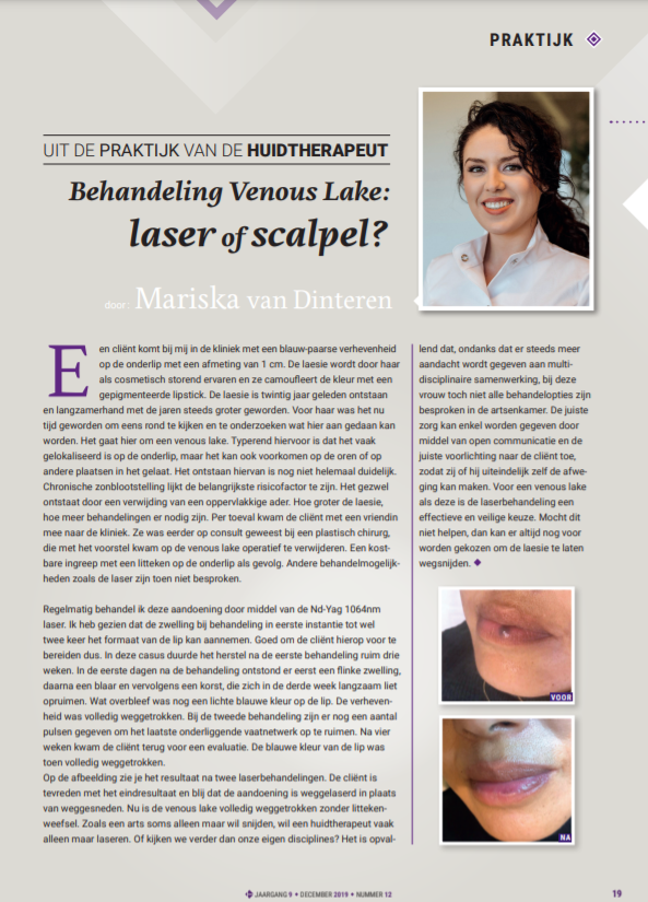 Artikel Mariska van Dinteren Behandeling Venous Lake: Laser of scapel?