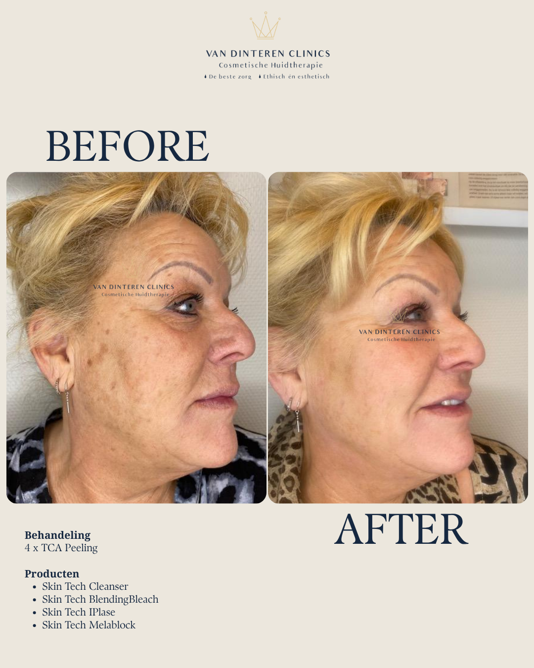 Voor en na TCA peeling