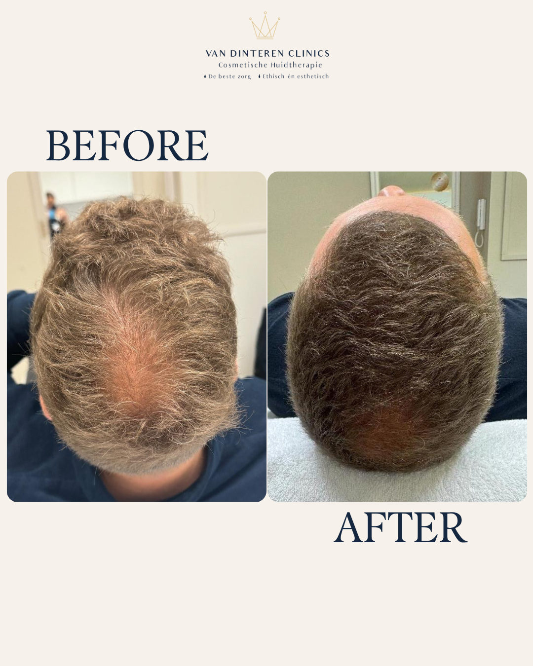 Voor en na XL hair
