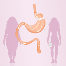 De virtuele maagband procedure richt zich op de (vaak onbewust) oorzaken van overgewicht